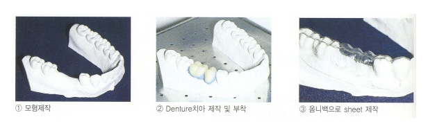 splint.jpg